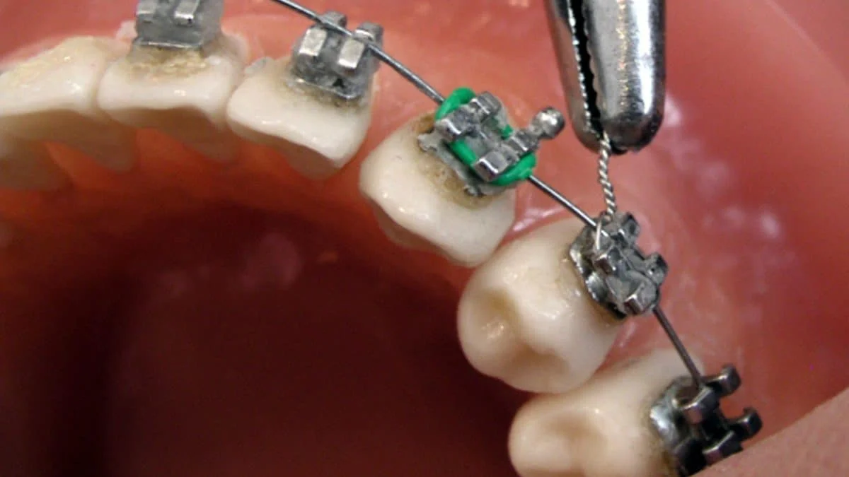 Мифы о брекетах у взрослых: стоматолог развенчивает страхи и сомнения
